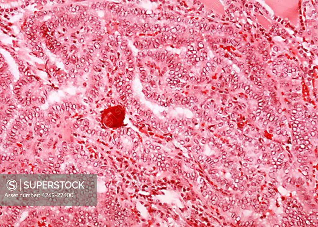 Papillary carcinoma. Photomicrograph of a section of thyroid showing a papillary carcinoma (red spot), a malignant tumor rich in calcifications.