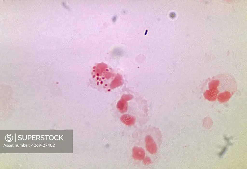Neisseria gonorrhoeae. Photomicrograph of Neisseria gonorrhoeae, an aerobic Gram-negative bacterium responsable for the Sexually transmitted infection Gonorrhea.