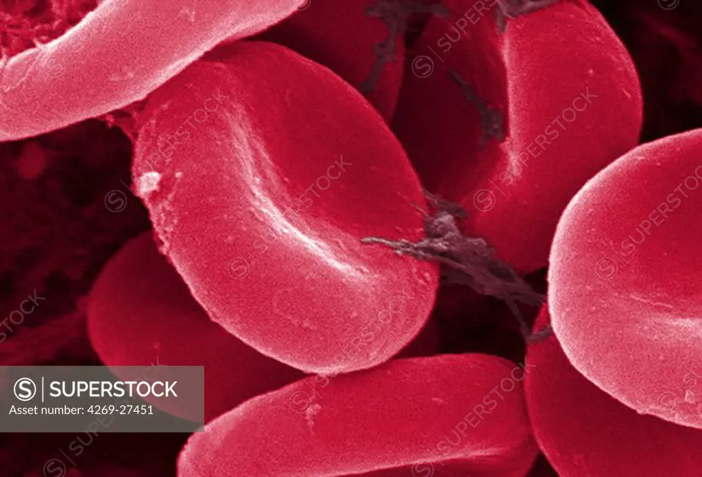 Red cell. Color enhanced scanning electron micrograph (SEM) of human red blood cells. Magnification 11397x.