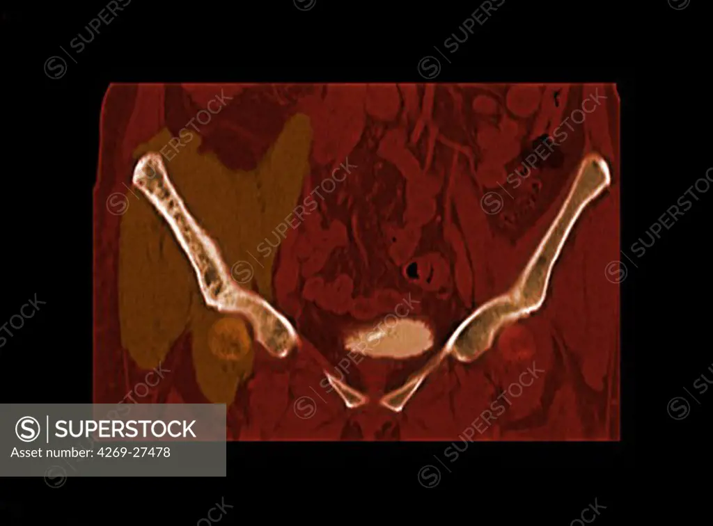 Bone lymphoma. Colored enhanced sagittal Computed Tomography (CT) scan of the pelvis showing a bone lymphoma on the right iliac wing (at left). The tumor appears as a ocre thickening around the iliac wing at left, and causes bone condensations (white concentrations at the surface of the bone).