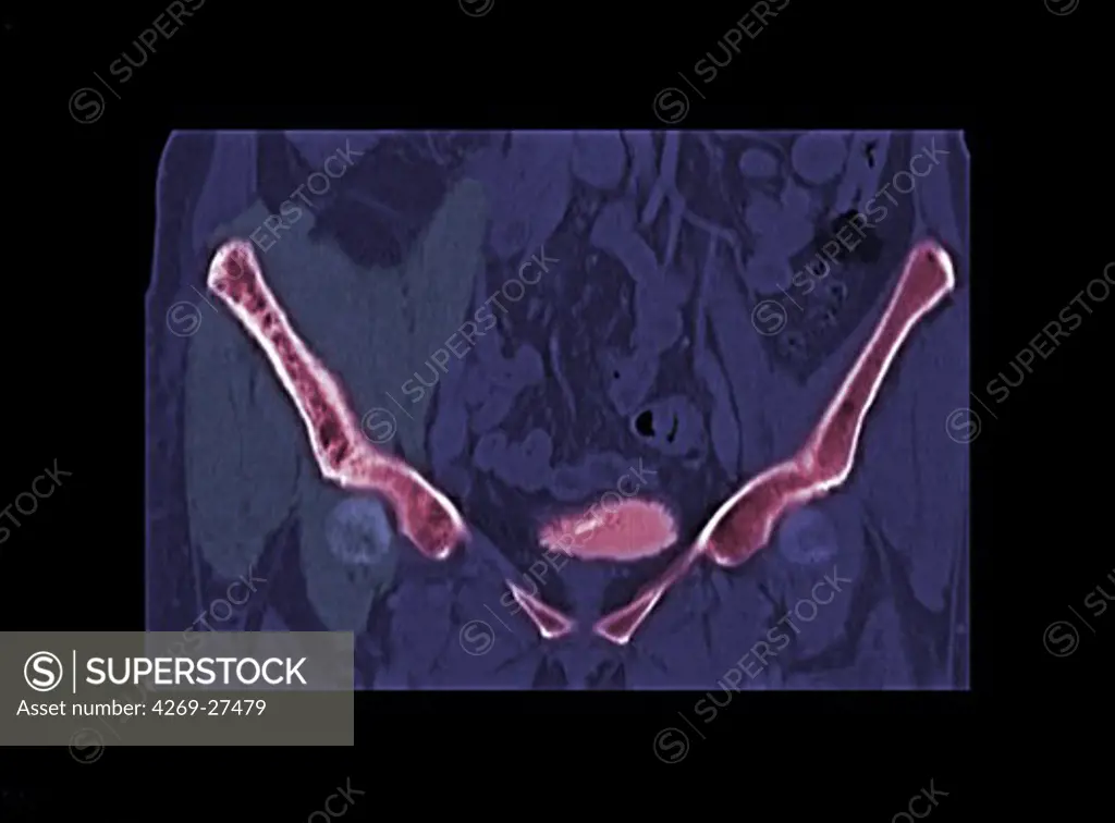 Bone lymphoma. Colored enhanced sagittal Computed Tomography (CT) scan of the pelvis showing a bone lymphoma on the right iliac wing (at left). The tumor appears as a grey thickening around the iliac wing at left, and causes bone condensations (white concentrations at the surface of the bone).