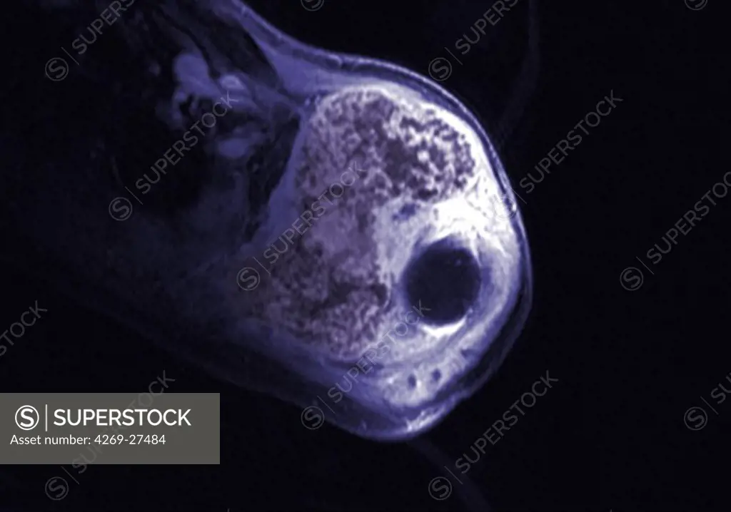 Shoulder chondrosarcoma. Axial MRI of the shoulder showing a chondrosarcoma of the shoulder blade. The tumor is evidenced by the presence of a heterogenous lytic area with bone calcifications. The black round shape at right is the head of the humerus inserted into the shoulder blade.