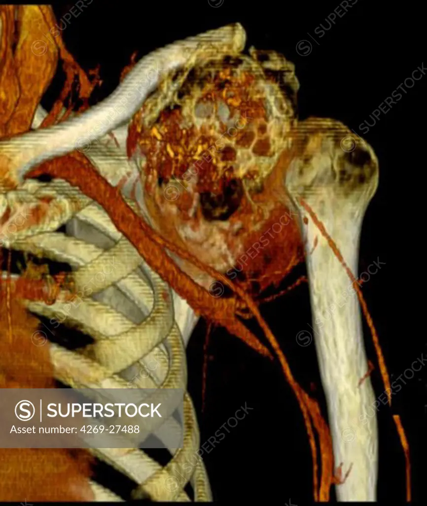 Shoulder chondrosarcoma. 3D Computed Tomography (CT) reconstruction scan of the shoulder showing a chondrosarcoma of the shoulder blade. The tumor is evidenced by the presence of a vascularized heterogenous lytic area with bone calcifications. The sub-clavian artery is seen in yellow.