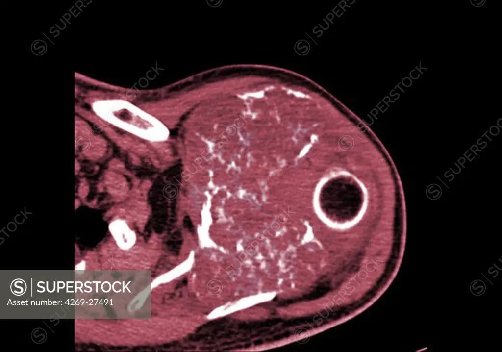 Shoulder chondrosarcoma. Colored enhanced Axial Computed Tomography (CT) scan of the shoulder showing a chondrosarcoma of the shoulder blade. The tumor is evidenced by the presence of a heterogenous lytic area with bone calcifications. The black round shape at right is the head of the humerus inserted into the shoulder blade.
