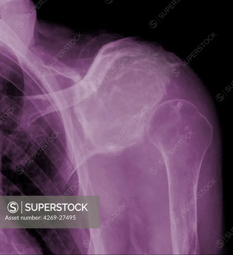 Shoulder chondrosarcoma. X-ray of the shoulder showing a chondrosarcoma of the shoulder blade. The tumor is evidenced by the presence of a vascularized heterogenous lytic area with bone calcifications.