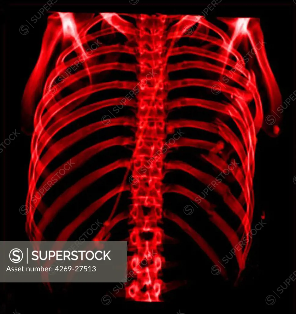 Costal fracture. 3D Computed Tomography (CT) reconstruction scan of the thoracic cage showing multiple fractured ribs.