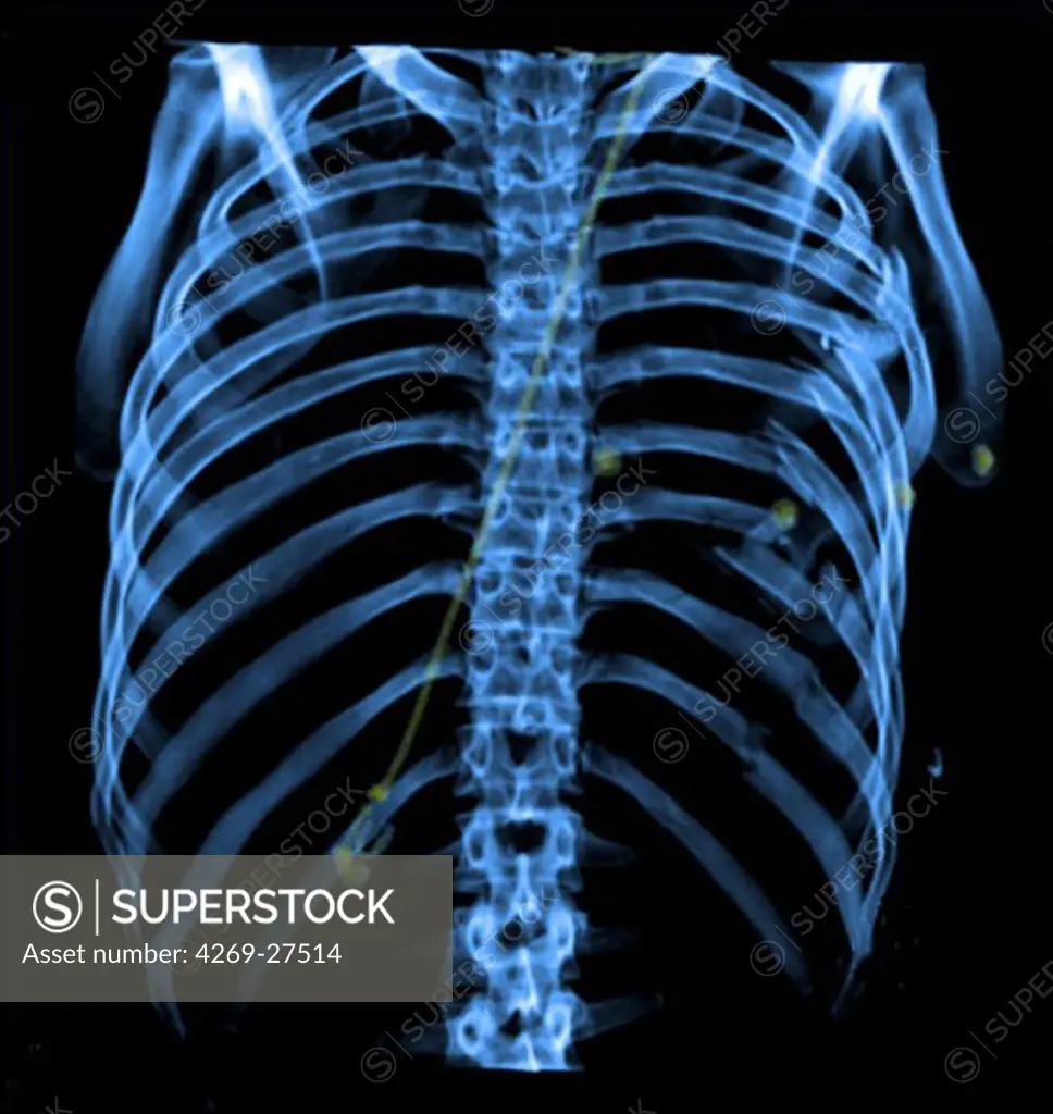 Costal fracture. 3D Computed Tomography (CT) reconstruction scan of the thoracic cage showing multiple fractured ribs.