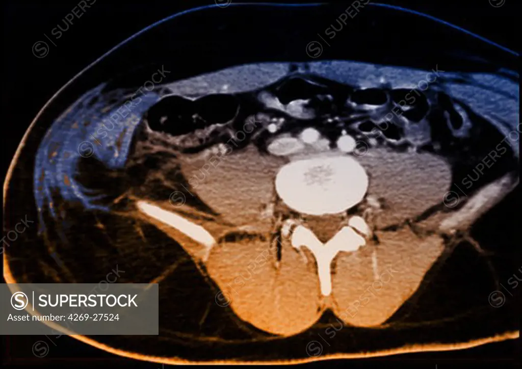 Ruptured abdominal wall. Axial Computed Tomography (CT) scan of the abdomen showing a ruptured right abdominal wall (at left), evidenced by the torn aspect of the muscles and the gap between the muscle (blue) and the iliac bone (white).