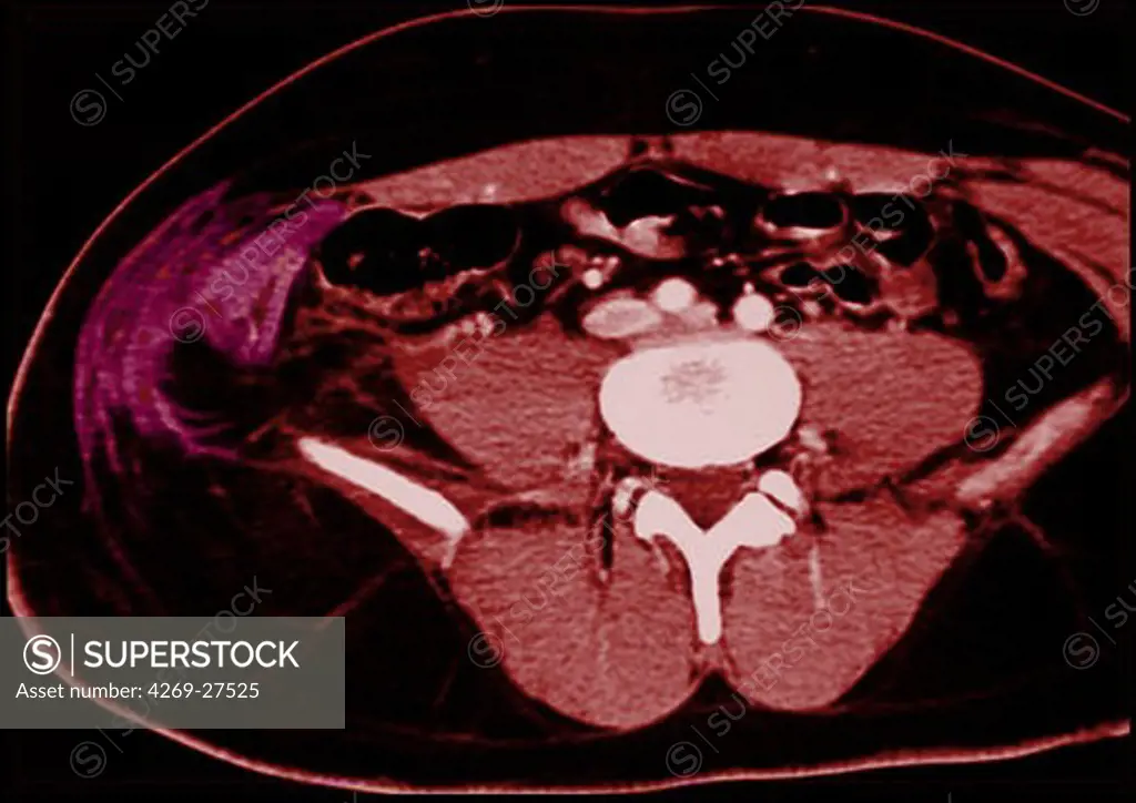 Ruptured abdominal wall. Axial Computed Tomography (CT) scan of the abdomen showing a ruptured right abdominal wall (at left), evidenced by the torn aspect of the muscles and the gap between the muscle (red) and the iliac bone (white).