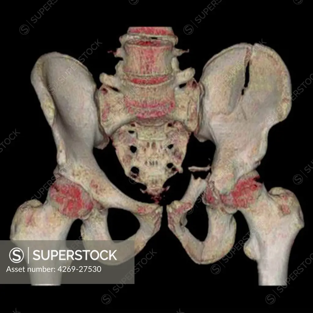 Fractured pelvis. 3D Computed Tomographic (CT) reconstruction scan of the pelvis showing a fractured left iliac wing (at right) and a fractured ischium.
