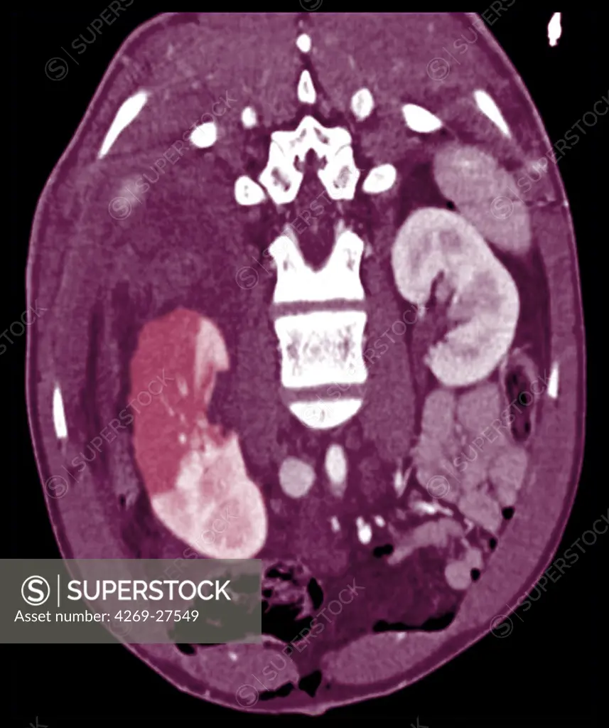 Renal infarct. Oblique axial Compted Tomography (CT) scan of the the trunc showing a partial right renal infarct. The infarcted (necrotic) areas of the kidney appears in dark pink (upper part of the kidney) while the healthy parts are in pale pink (lower part). Renal infarct is caused by deficient blood irrigation of the kidney.