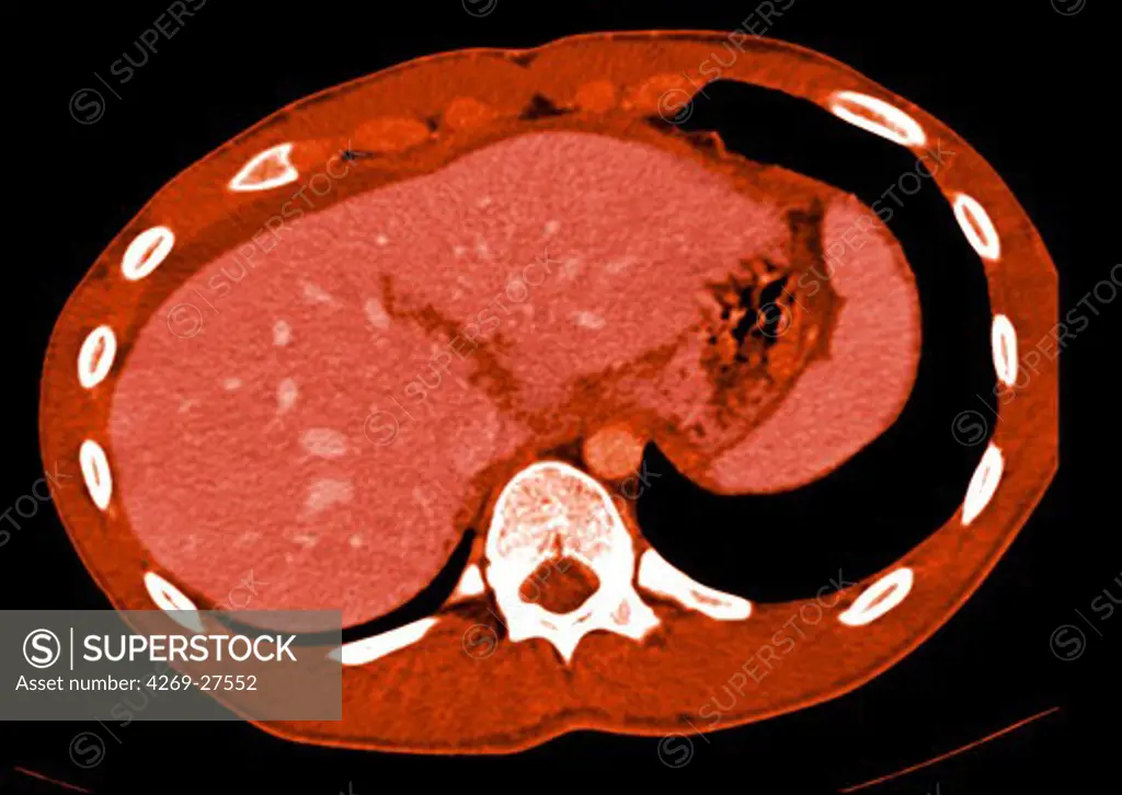 Hepatic fracture. Axial Computed Tomography (CT) scan of the abdomen showing a fracture of the liver (dark orange lesions in the middle and at right of the liver) further to a shock (road accident).