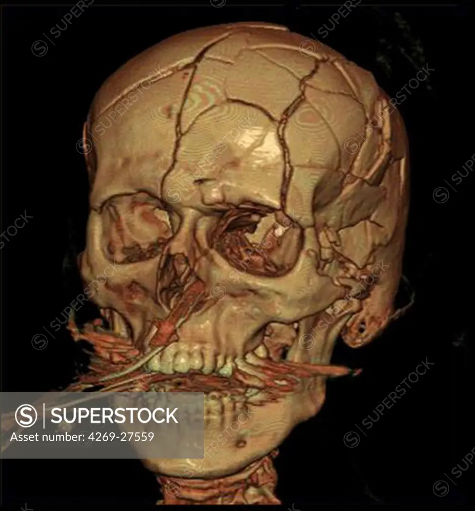 Cranial trauma. 3D Computed Tomographic (CT) reconstruction scan of the skull with multiple fractures (road accident).