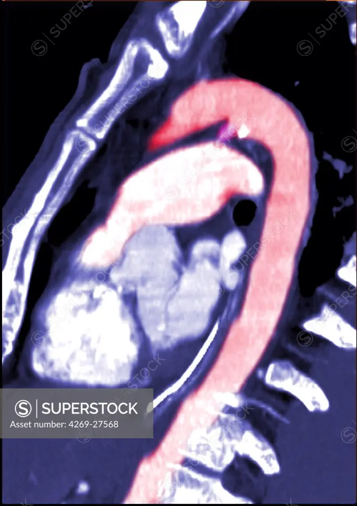 Ductus arteriosus. Sagittal Computed Tomography (CT) scan of an abnormal patent ductus arteriosus caracterized by the presence of a canal between the aorta (in pink at top) and the pulmonary artery (in white, below). This canal is normally found in the foetus and disappears before birth.