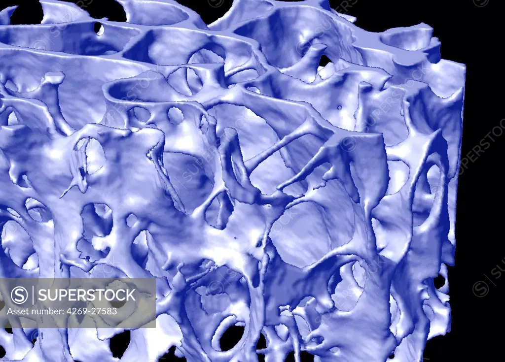 Osteoporosis. Institute of Prevention and Researches on Osteoporosis (IPROS), Porte Madeleine Hospital, Orléans, France. The unit 658 of the French National Institute for Health and Medical Research (Inserm) carries researches on bone characterization. Here, a 3D micro CT scan of a fractured neck of the femur with osteoporosis.