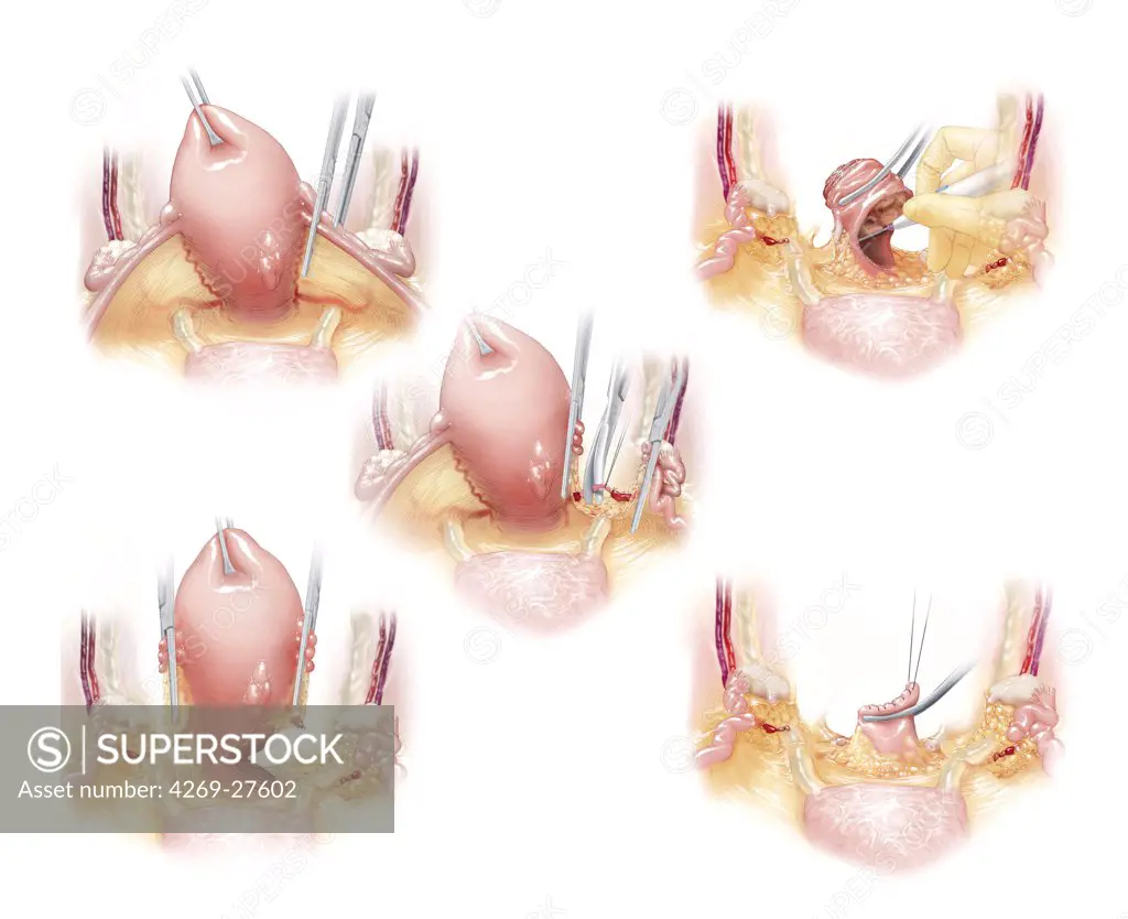 Hysterectomy. Artwork of hysterectomy (ablation of the uterus) in 5 steps.
