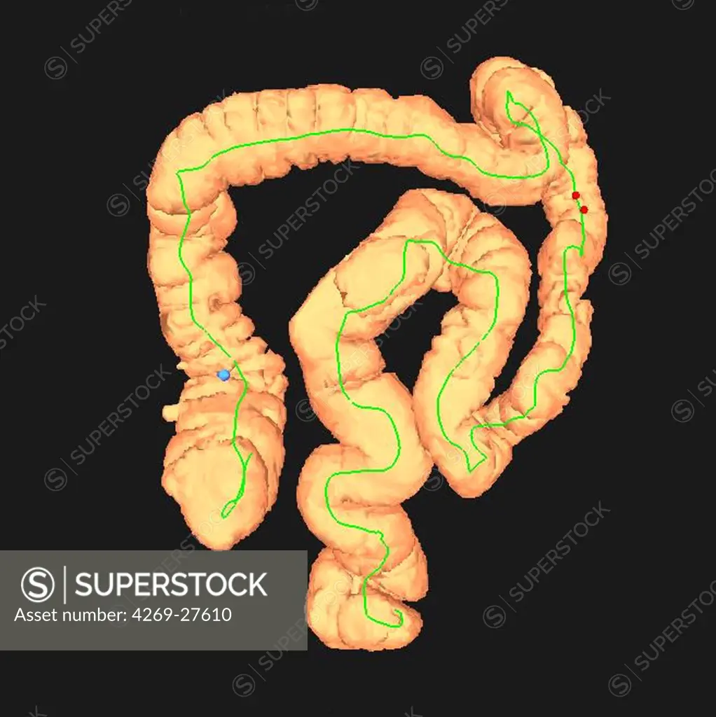 Virtual colonoscopy. 3D computed tomography (CT) scan of the colon.