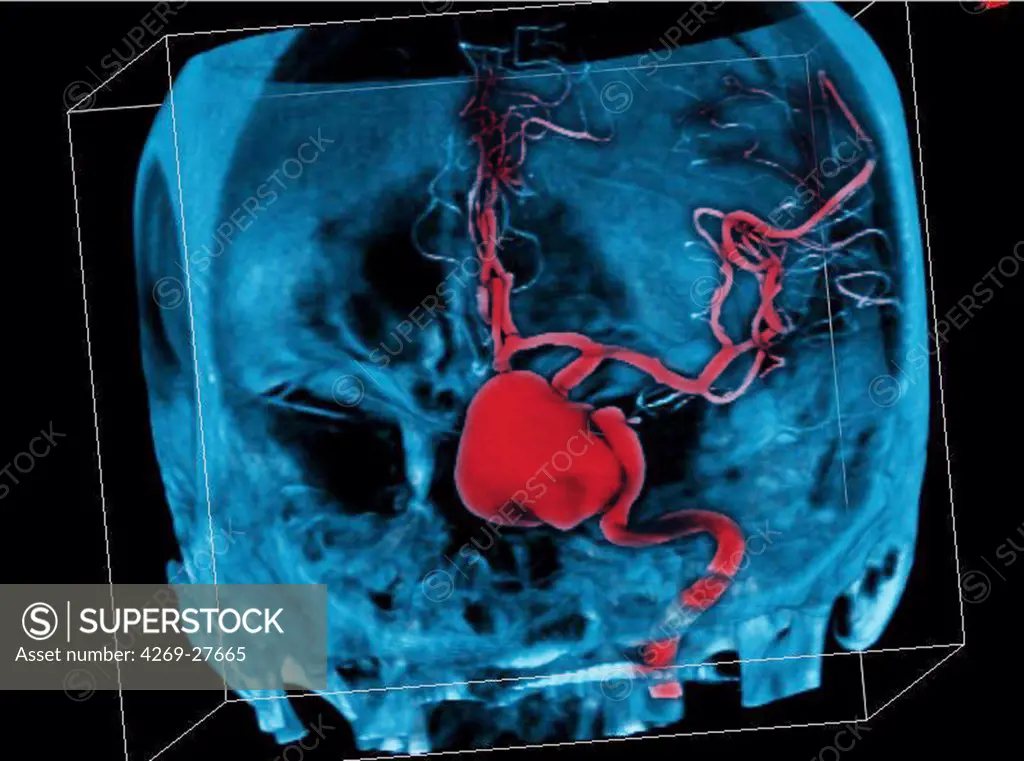 Cerebral aneurysm. Three-dimensional computed tomographic (CT) scan reconstruction of a skull showing an intracranial aneurysm (red ballon shaped swelling) located in the arterial circle of Willis  (where the basilar artery and internal carotid arteries meet). An aneurysm is a bulge of a vessel due to the dilatation of its wall. A ruptured aneurysm can be fatal.