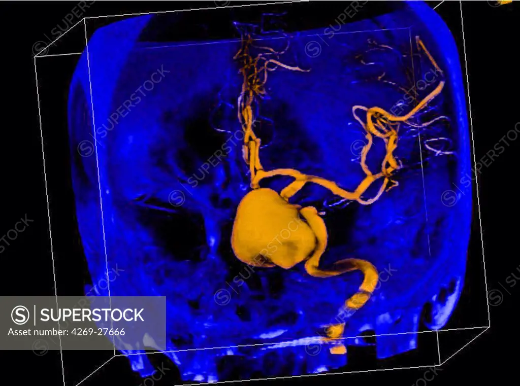 Cerebral aneurysm. Three-dimensional computed tomographic (CT) scan reconstruction of a skull showing an intracranial aneurysm (yellow ballon shaped swelling) located in the arterial circle of Willis  (where the basilar artery and internal carotid arteries meet). An aneurysm is a bulge of a vessel due to the dilatation of its wall. A ruptured aneurysm can be fatal.