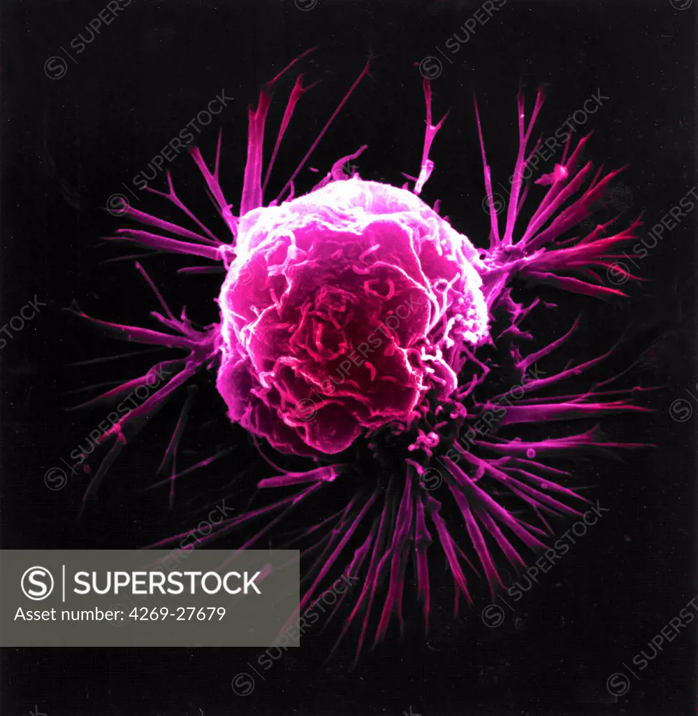 Cancer Cell. Scanning electron micrograph (SEM) of a breast cancer cell.