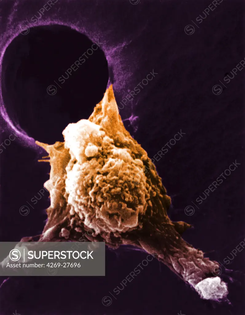 Malignant cell. Scanning electron micrograph (SEM) of a cancerous cell showing pseudopodia ( pseudopod ). This 'arms' are generated by a protein named autocrine motility factor (AMF) enabling them to migrate to other parts of the body. Locomotion is integral to the entire process of metastasis.