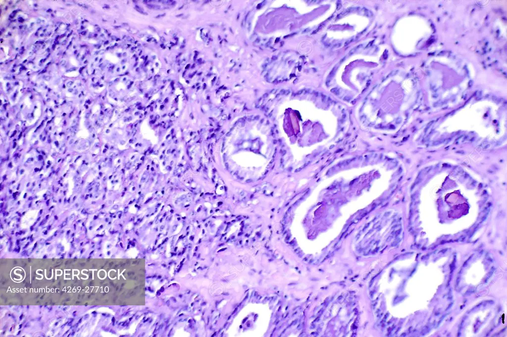 Prostate cancer. Histological slide of prostate tissus showing prostate cancer. On the right is a moderately differentiated cancer. On the left is highly undifferentiated. Magnified 300x.