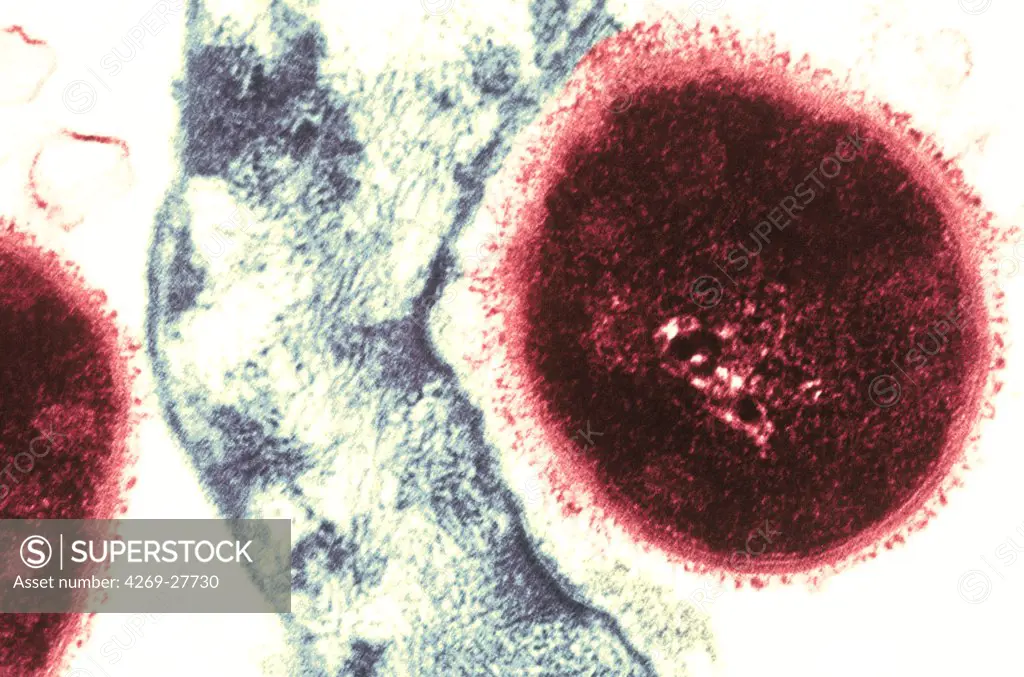 Streptococcus pneumoniae. Color enhanced Transmission electron micrograph (TEM) of type 4 Streptococcus pneumoniae bacteria adherent to a pharyngeal epithelial cell. This Gram-negative bacterium is a leading cause of pneumonia. It also causes many other pathologies like middle ear infections (otitis media), bacteremia and meningitis.