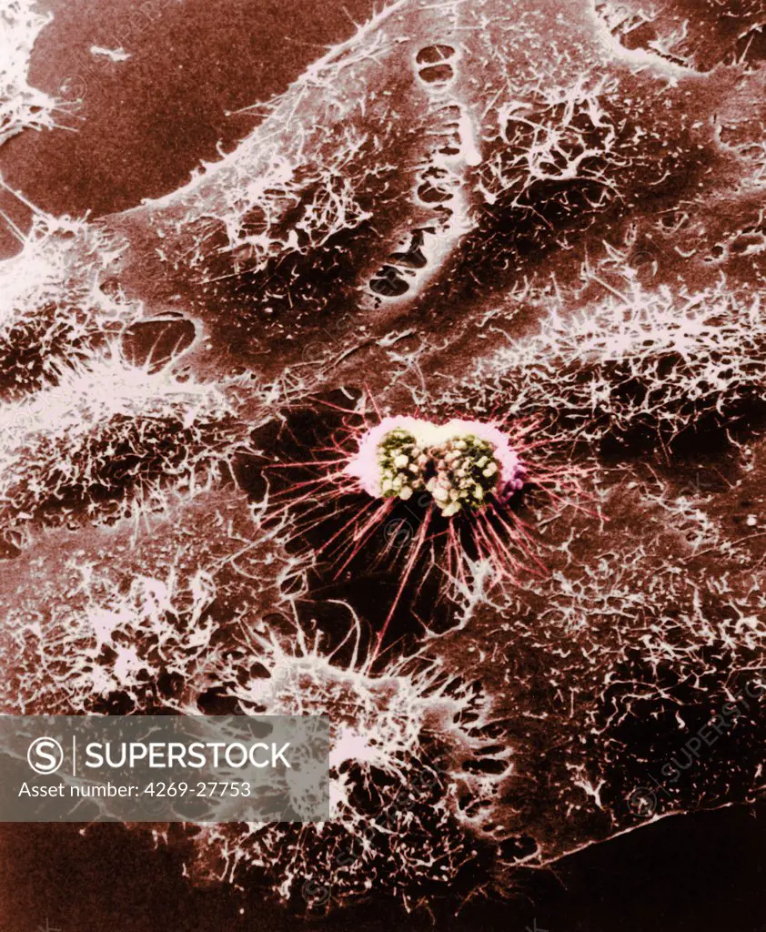 Cancer cell. Color enhanced scanning electron micrograph (SEM) of cultured HeLa cells originally derived many years ago from a woman's cancerous cervical tissue in the process of dividing.