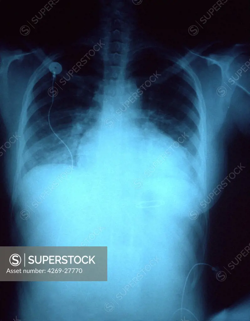 Congestive heart failure. Chest X-ray of a person suffering from congestive heart failure secondary to chronic hypertension or high blood pressure. The size of the heart is abormally big. CHF often causes pulmonary congestion and water retention in the body.