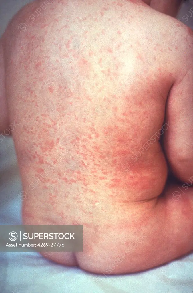 Rubella. Rash of rubella on skin of child's back.