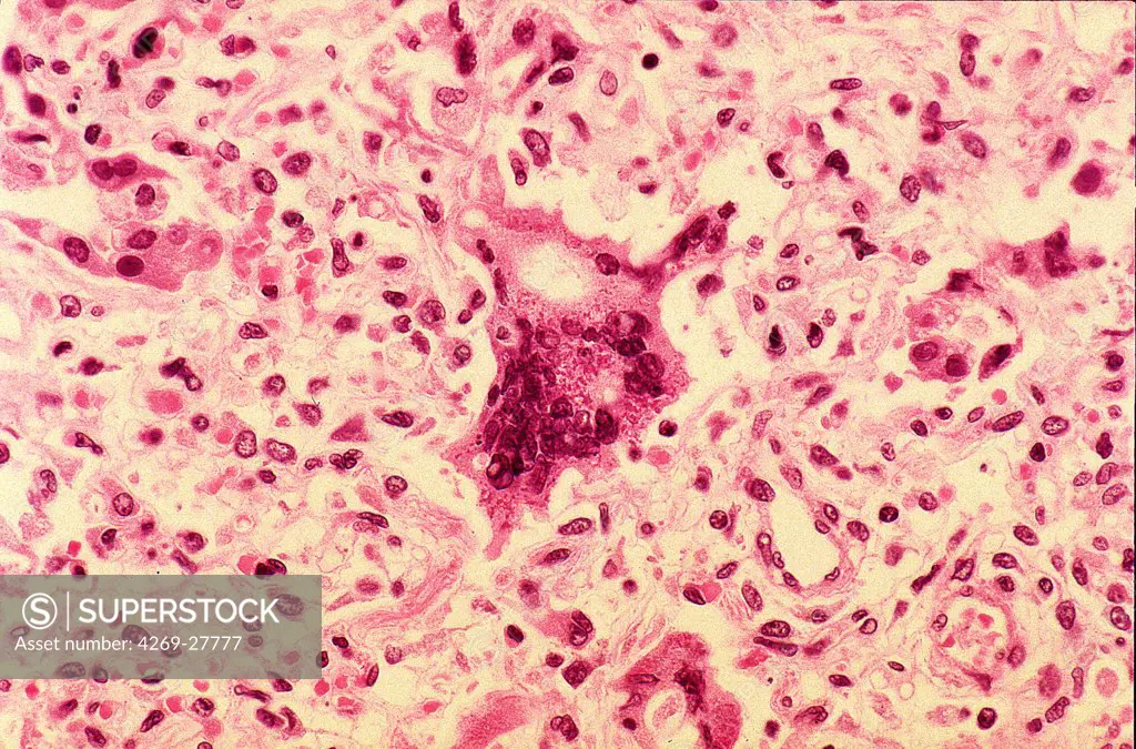 Giant cells pneumonia. Photomicrograph of lung tissus with giant cells pneumonia (measles pneumonia), a serious complication of measles.