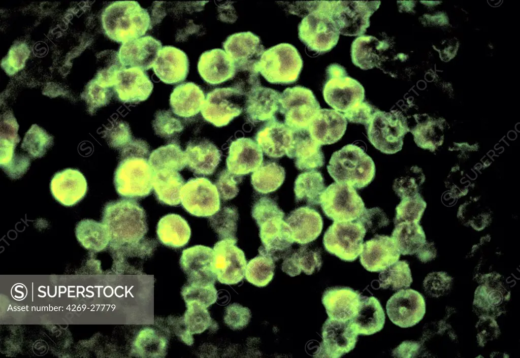 Naegleria fowleri. Brain tissue with amebic infection with Naegleria fowleri, a free-living amebae responsible for primary amebic meningoenceohalitis. Fluorescence light micrograph.