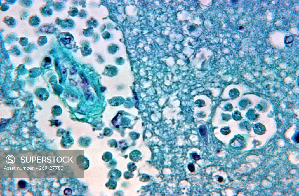 Naegleria fowleri. Brain tissue with amebic infection with Naegleria fowleri, a free-living amebae responsible for primary amebic meningoenceohalitis. Light micrograph, magnification x500.