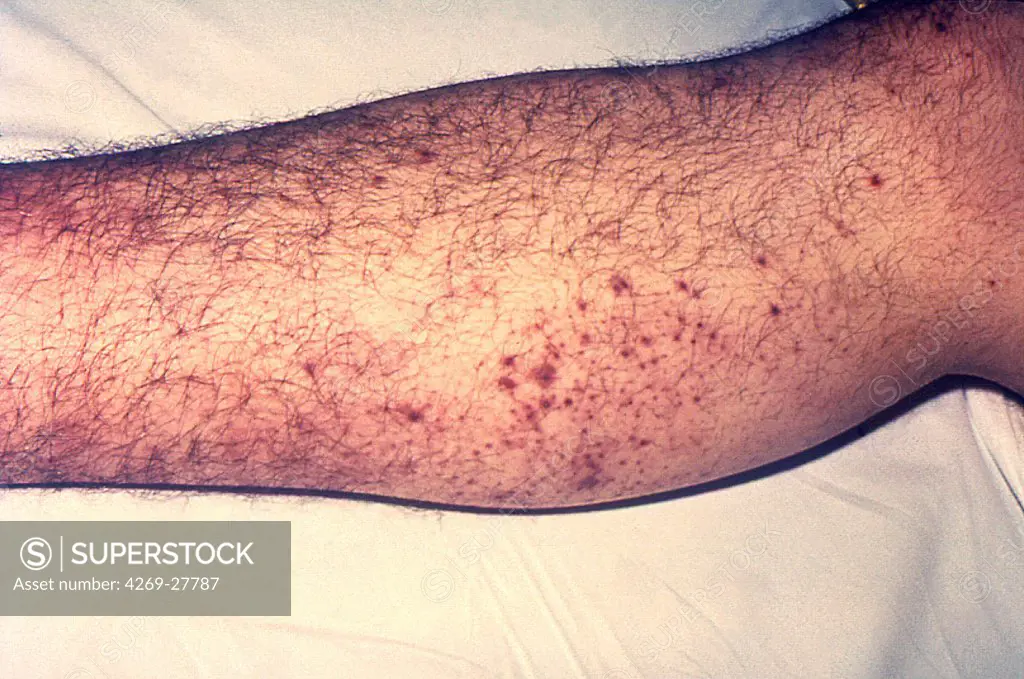 Plague. Small hemorrhages on the calf skin of a plague victim, due to capillary fragility, one of the manifestations of a plague infection.