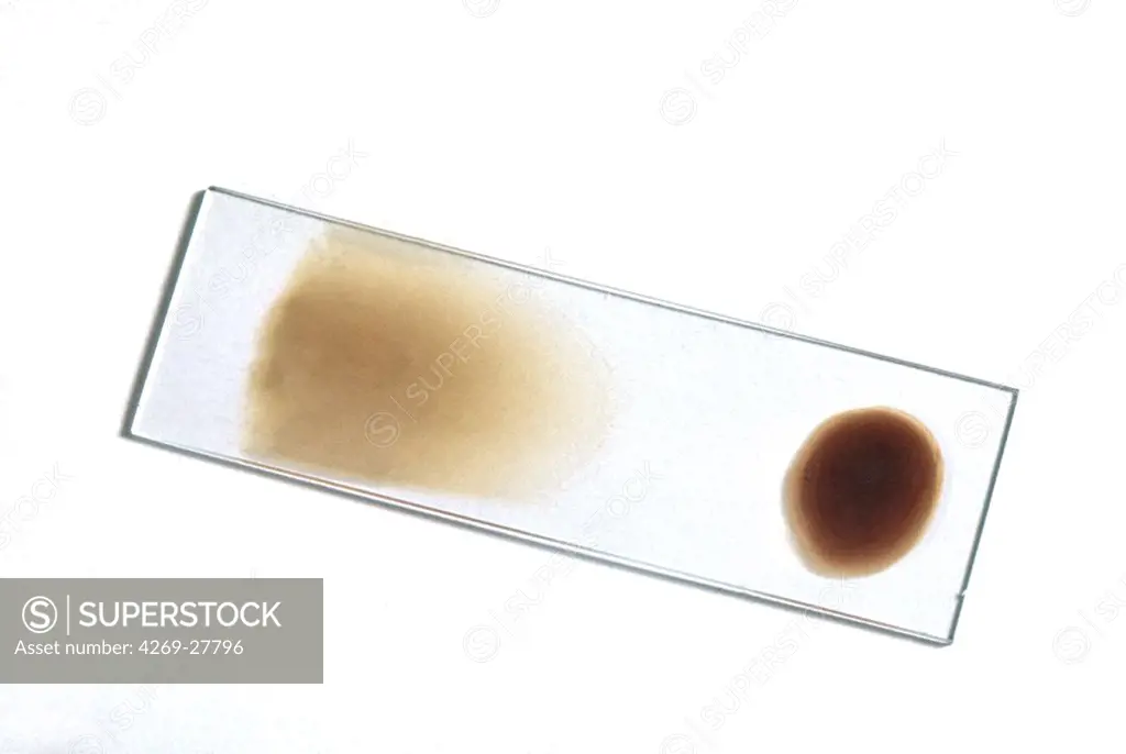 Blood analysis. Glass slide with a thin layer of blood at left (blood smear) and a thick layer at right (thick blood film) used for a microscopic quantity and quality blood cells analysis.