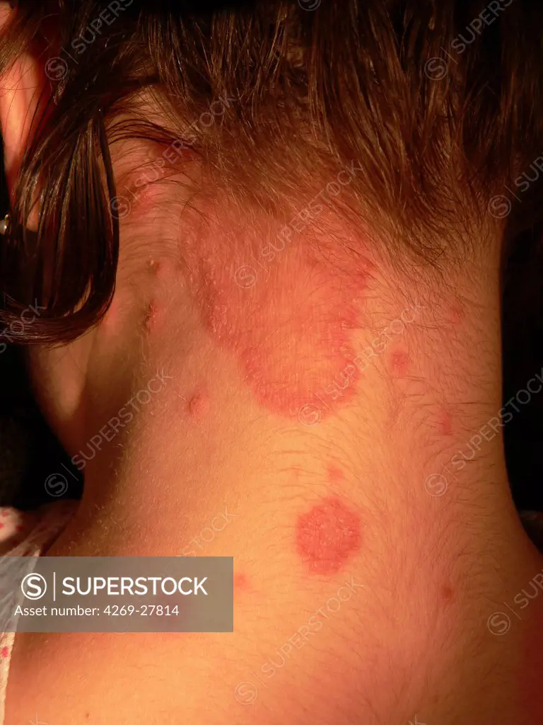 Dermatophysis. Dermatophytosis caused by the skin fungus Microsporum canis.