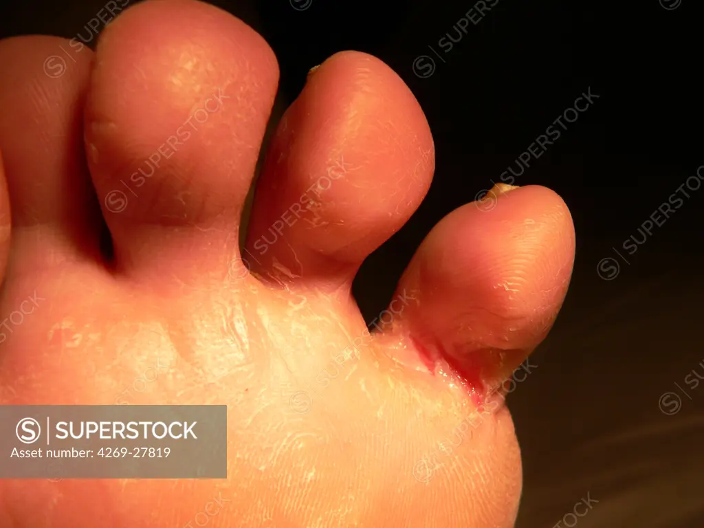 Onychomycosis. Onychomycosis (fungal nail affection) and intertrigo (athlete's foot or tinea pedis) caused by the fungus Trychophyton Rubrum.