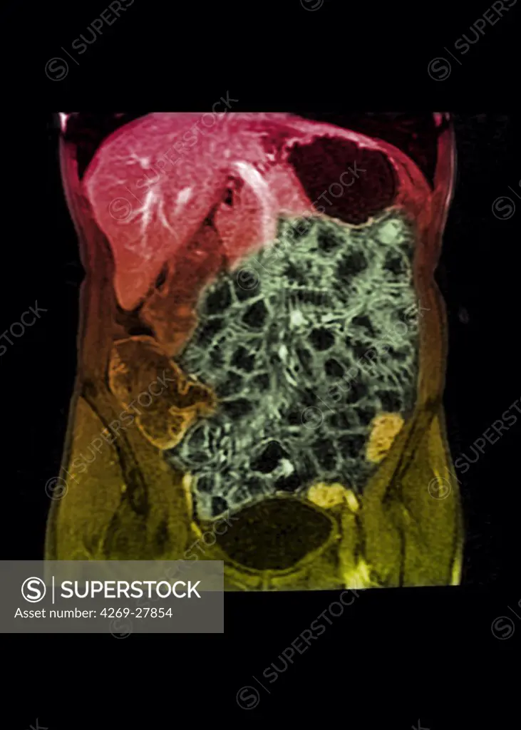 Small intestine. Colored MRI (Magnetic Resonance Imaging) scan of the abdomen showing  the small intestine (green). Are also seen the liver at top (red), the stomach at right (black), part of the large intestine at left, and the baldder at bottom (black).