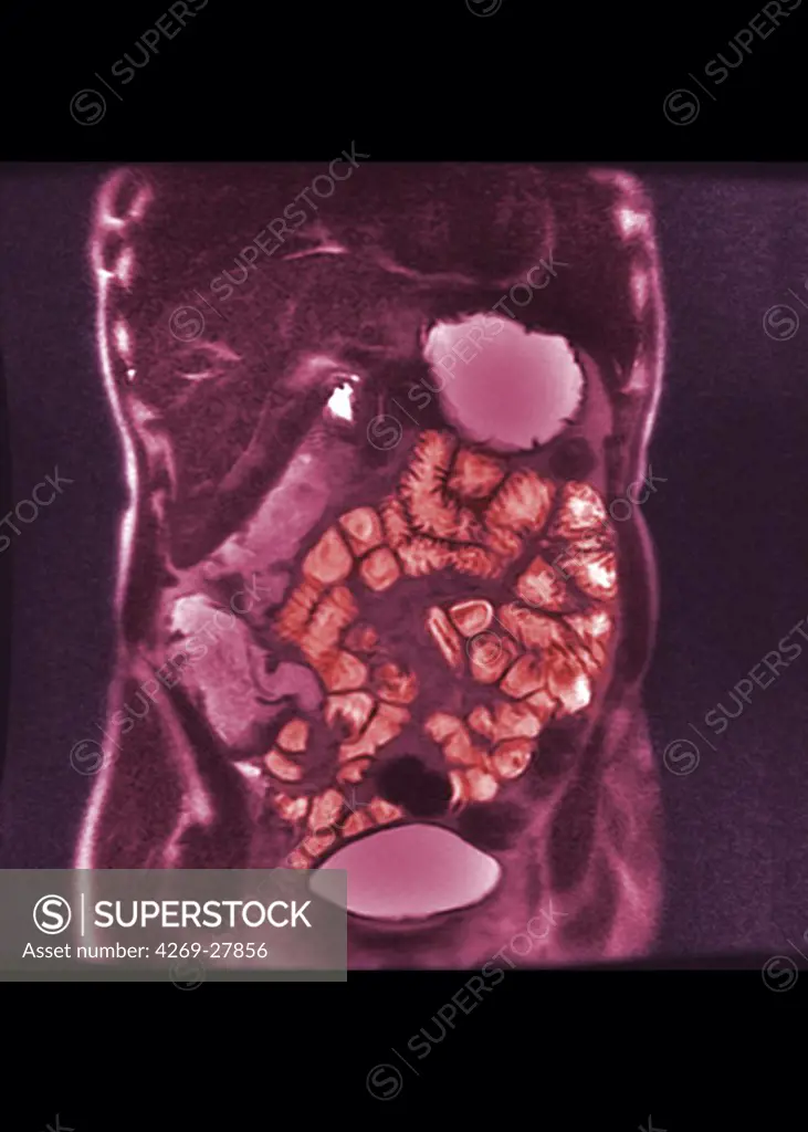 Small intestine. Colored MRI (Magnetic Resonance Imaging) scan of the abdomen showing the small intestine (orange). Are also seen the liver at top (black), the stomach at right, part of the large intestine at left, and the baldder at bottom.