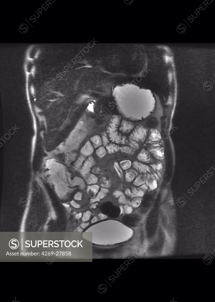 Small intestine. Colored MRI (Magnetic Resonance Imaging) scan of the abdomen showing  the small intestine (center). Are also seen the liver at top (black), the stomach at right, part of the large intestine at left, and the baldder at bottom.