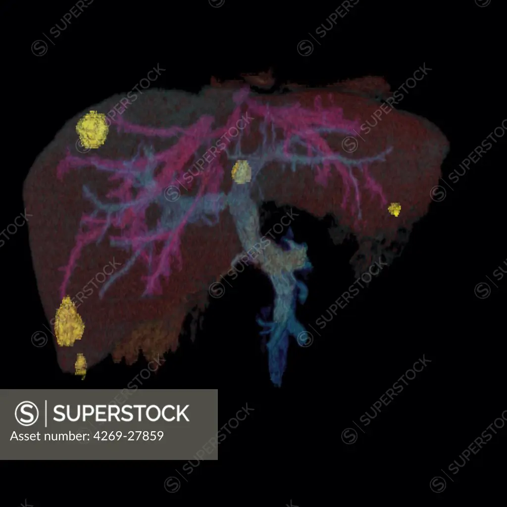 Hepatic metastasis. Three-dimensional computed tomographic reconstruction scan of the liver showing metastasis (yellow) from a primary colorectal cancer.