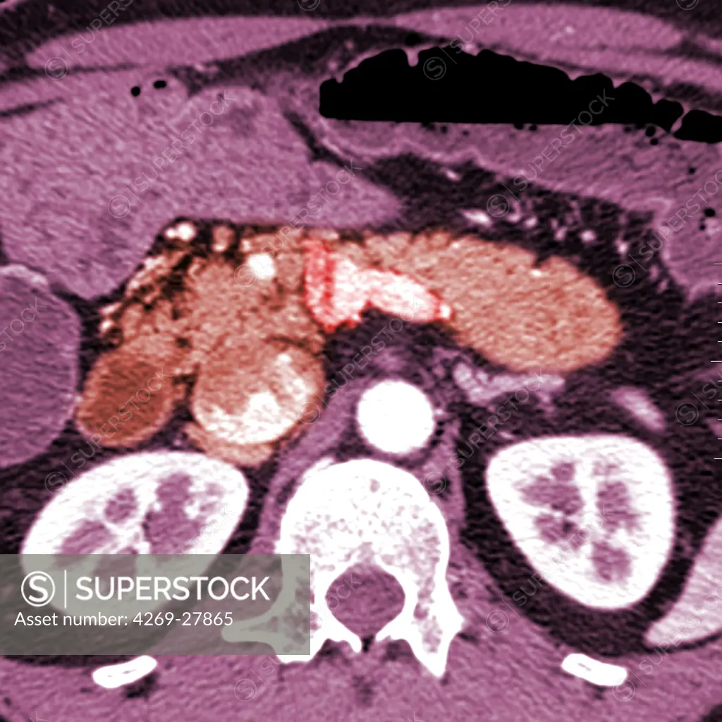 Pancreas tumor. Colored Computed Tomography (CT) scan of the abdomen showing a tumor of the pancreas (center).
