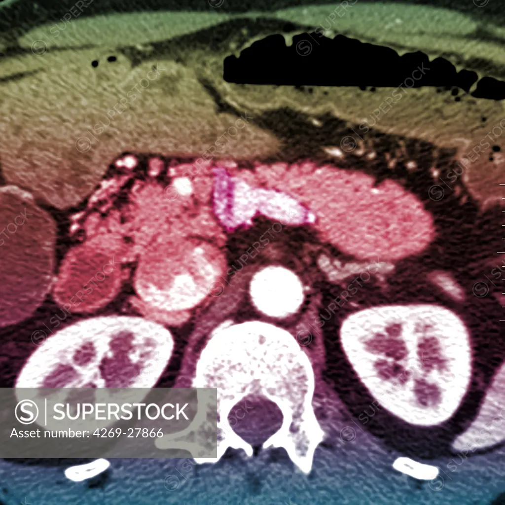 Pancreas tumor. Colored Computed Tomography (CT) scan of the abdomen showing a tumor of the pancreas (center).