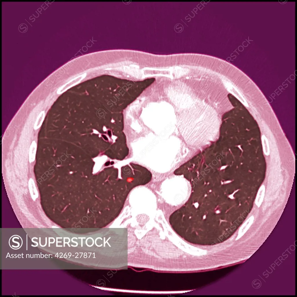 Lung cancer. Colored Computed Tomography (CT) scan of the abdomen showing early stage lung cancer. The tumor is seen as a small red spot.