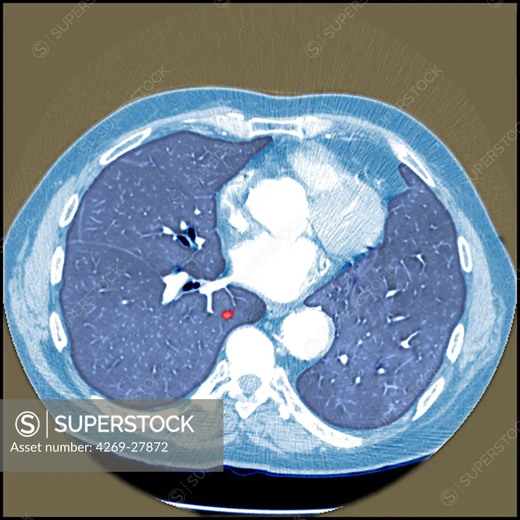 Lung cancer. Colored Computed Tomography (CT) scan of the abdomen showing early stage lung cancer. The tumor is seen as a small red spot.