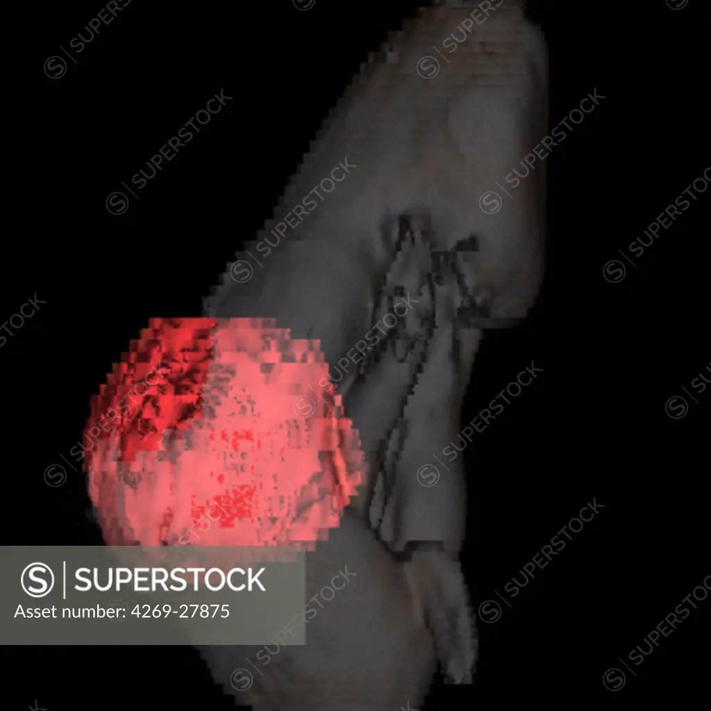 Kidney cancer. Three-dimensional computed tomographic reconstruction scan of of a kidney with massive tumor (red).