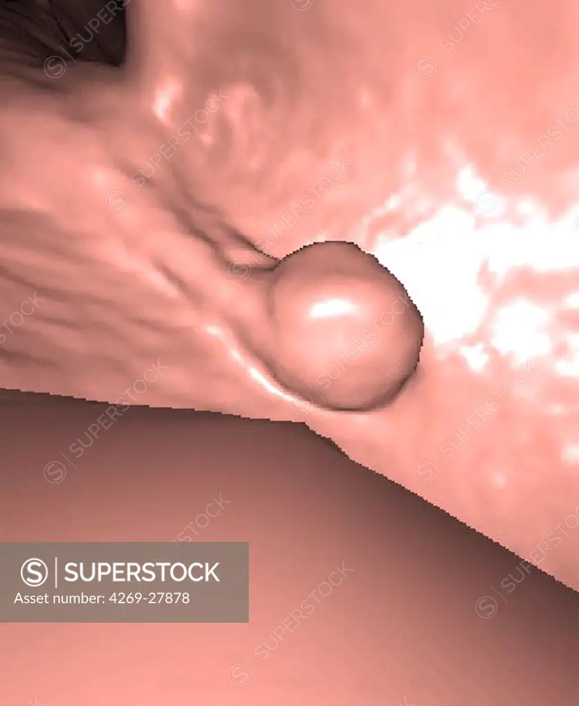Polyp on the colon. A 3D computed tomography (CT) scan of the colon, showing a polyp.