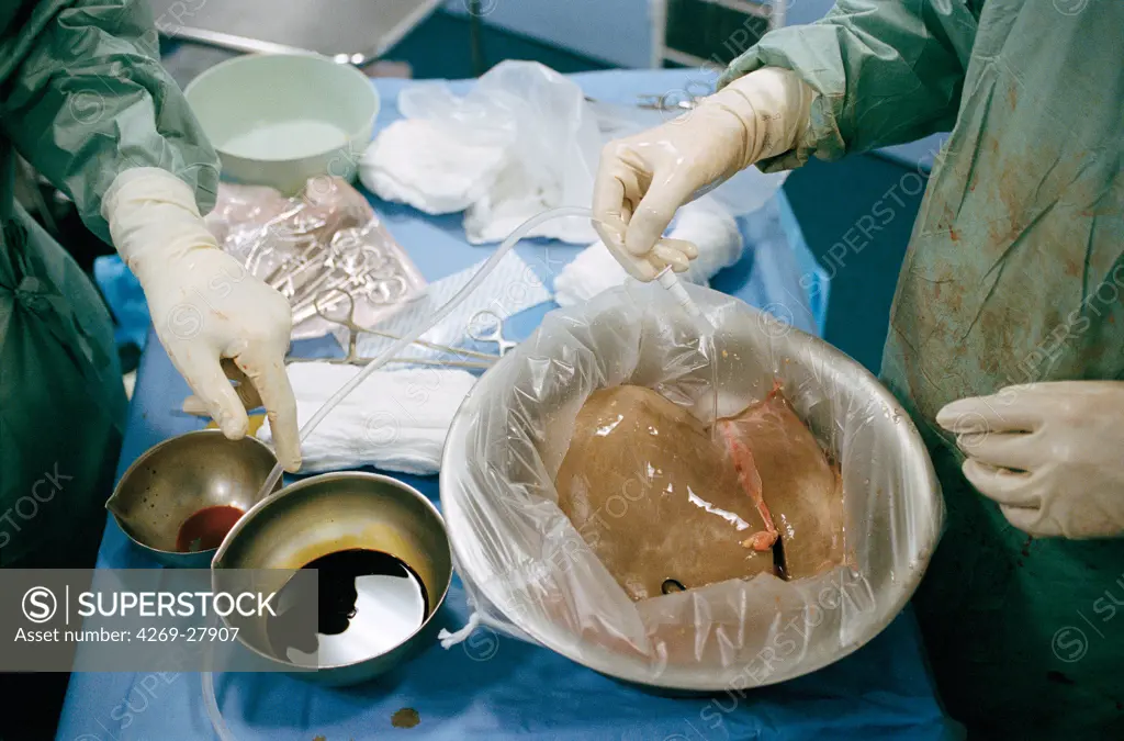 Organ retrieval. Surgical team removing liver from donor to be transplanted. Versailles hospital, France.