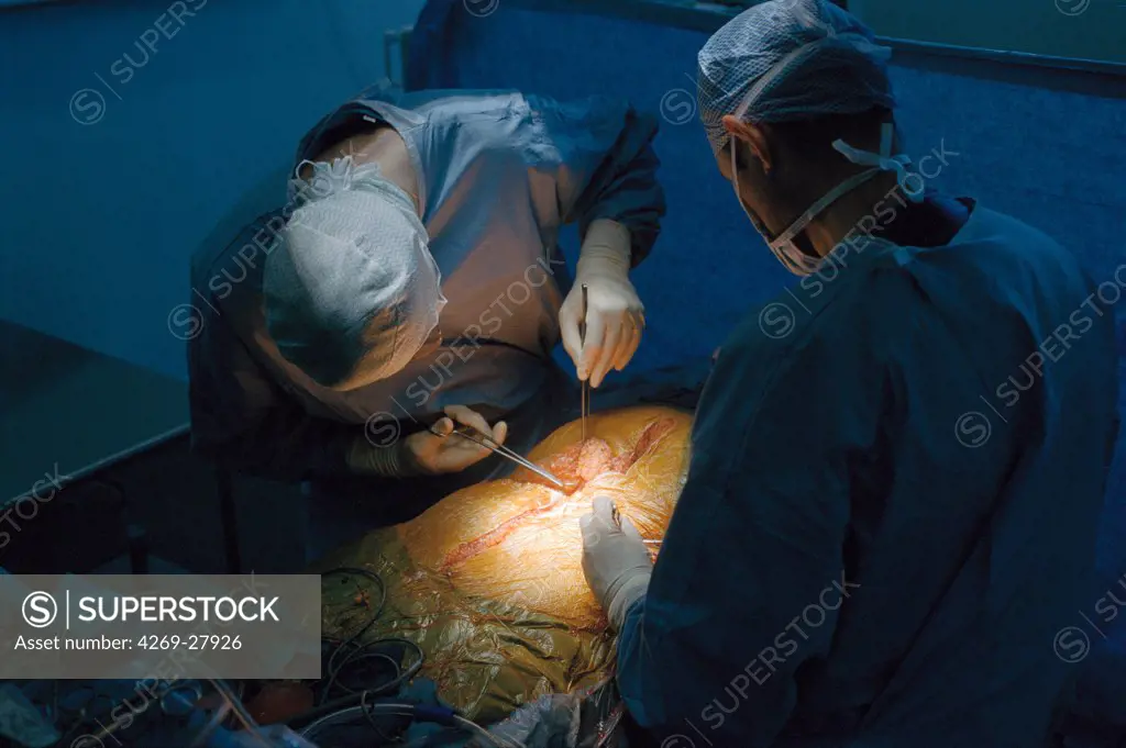 Organ graft. Surgeon performing tegumentary restitution (body reconstitution) on corpse of organ donor after organ retrieval. Beaujon hospital, Clichy, France.