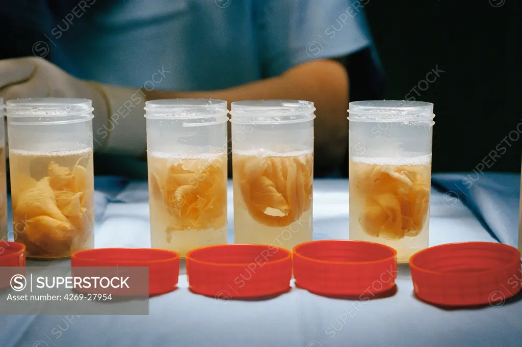 Tissue bank. Technician soaking skin transplants into antibiotic and cryoprotectant solution before preservation. Human tissue bank, Saint Louis hospital, Paris, France.